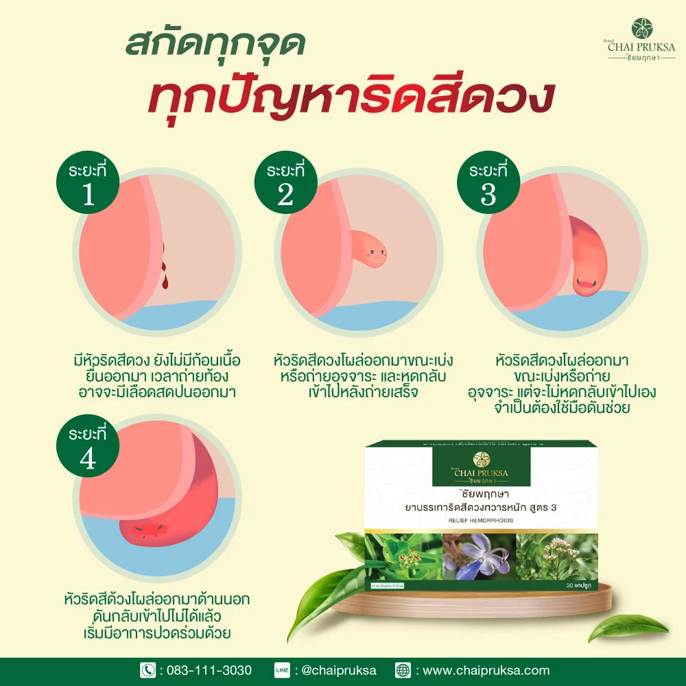ประเภทของริดสีดวง